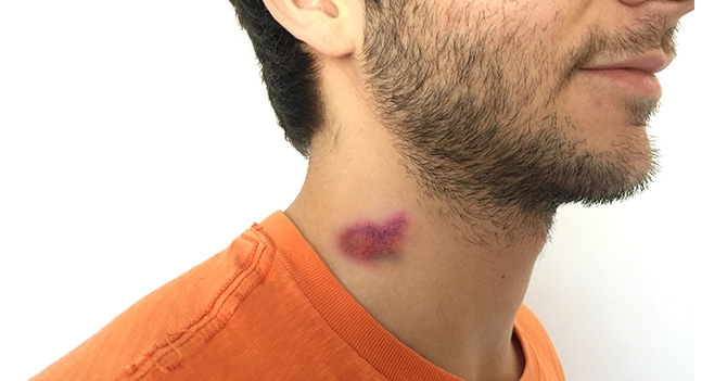 Joven continúa diciendo que chupón en el cuello se lo hizo con la manilla de la puerta