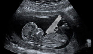 HERMOSO: Feto caraqueño empieza a desarrollar pistola en el vientre